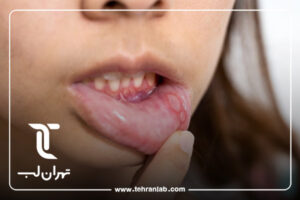HPV-و-سرطان-دهان