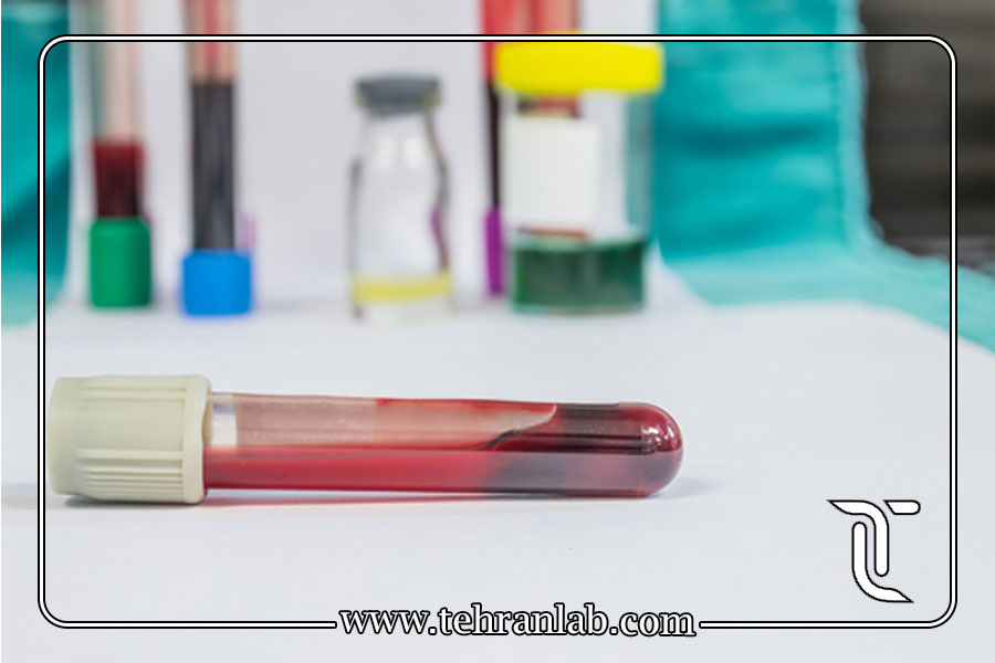 آزمایش AFP یا CA 19-9