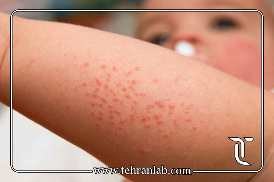 تست آلرژی پوستی یا تست آلرژی خونی