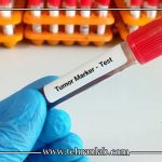 تکرار تومور مارکر