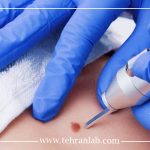 درمان زگیل تناسلی