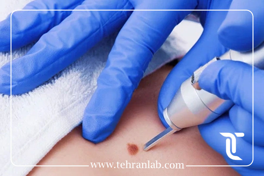 درمان زگیل تناسلی